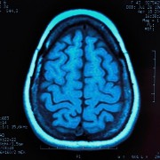 Anoxic Brain Injury related image